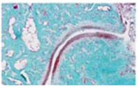 25 Rheumatoide Arthritis