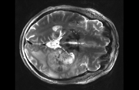 Magnetresonanztomographische Aufnahmen eines Glioblastoms. Bild: DKFZ