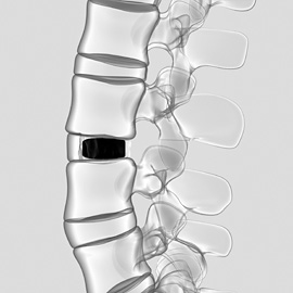 Ein PlivioPore-Implantat nach der Fixierung. Nach kurzer Zeit verwachsen die benachbarten Wirbel mit dem Implantat. Bild: Forschungszentrum Jülich