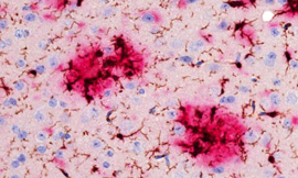 Mausgehirn mit Alzheimer Plaques (in Rot) und den hirneigenen Freßzellen (Mikroglia, in Braun). Bild: DZNE/Universität Rostock