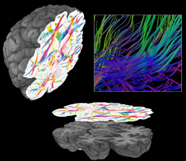 Die in Jülich entwickelte dreidimensionale Bildgebung mit polarisiertem Licht ermöglicht die räumliche Darstellung von Nervenfaserbahnen im menschlichen Gehirn mit einer Auflösung von bis zu einem...