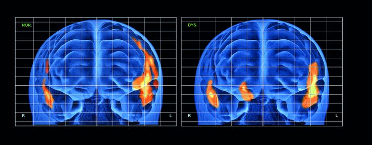 Gestörte Durchblutung. 3D-Rekonstruktion eines gesunden männlichen Gehirns (links) und des Gehirns eines Mannes mit Lesestörung (rechts), während beide Personen
vorlesen. Beim gesunden Gehirn steigt die Gehirndurchblutung in Bereichen, die für Sprache, Hören und Sehen zuständig sind. Beim legasthenen Gehirn tritt außerdem eine
Zunahme des Blutflusses im Pallidum (P) auf, das eigentlich an der Steuerung unbewusster Bewegungen beteiligt ist. Bild: SOVEREIGN/ISM/Agentur Focus